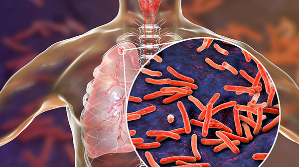 Las bacterias de la Tuberculosis se transmiten por el aire, de una persona a otra