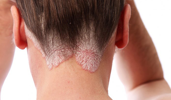La Psoriasis: afección crónica de la piel causada por un sistema inmunitario hiperactivo