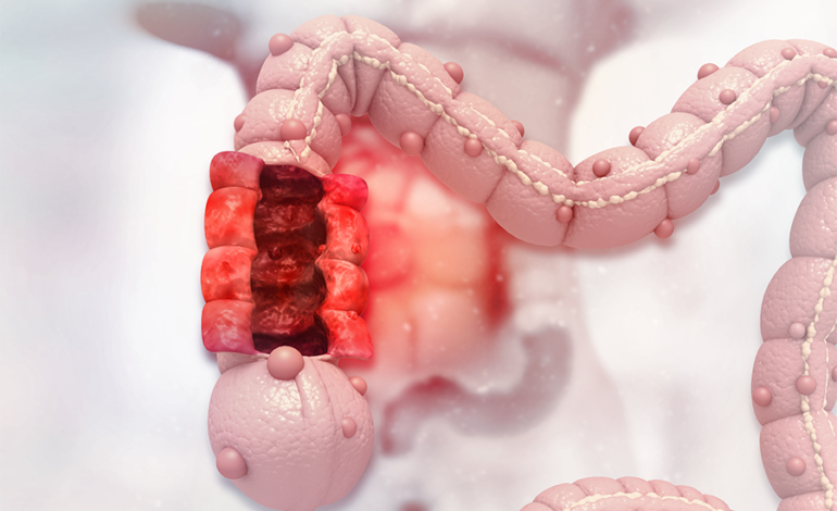 Aumenta cáncer colorrectal en los adultos jóvenes