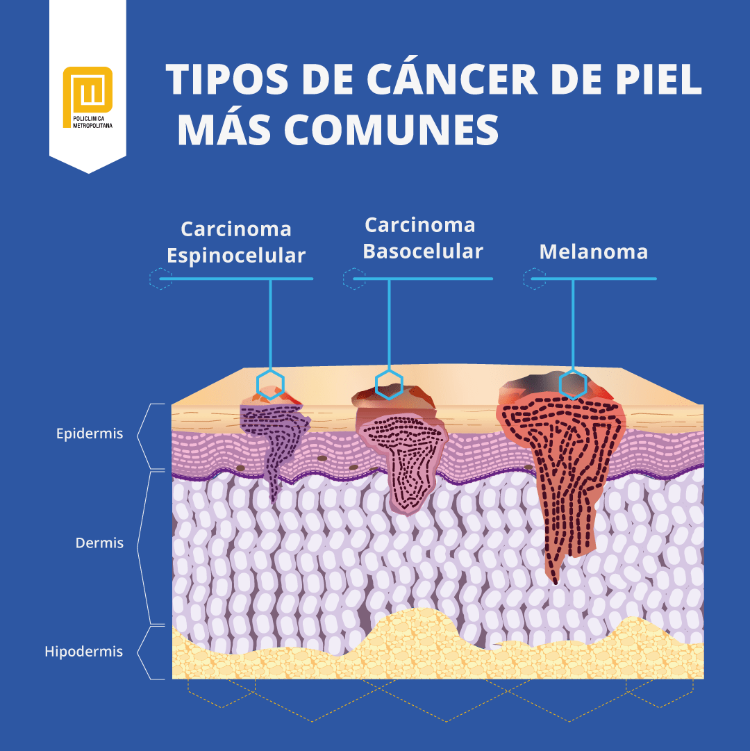 Cáncer de piel - Trabajador Inmigrante